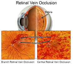 Retinal_vein_occlusions