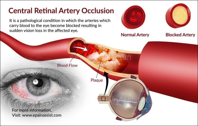 . RETINAL ARTERY OCCLUSION