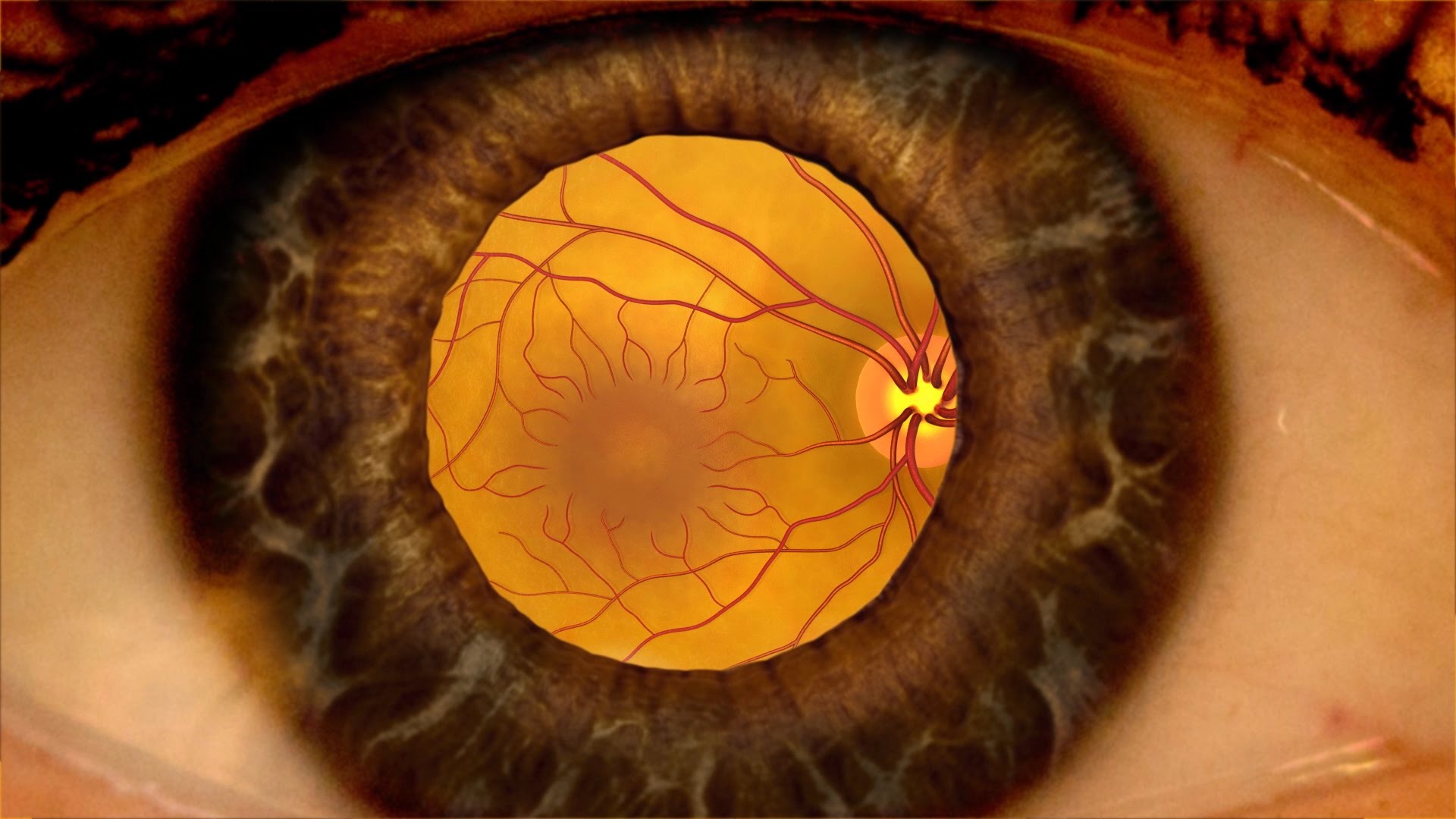 diabeticretinopathy