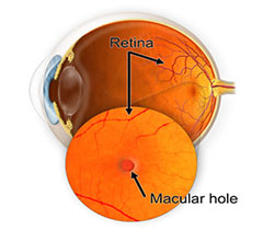 macular_hole