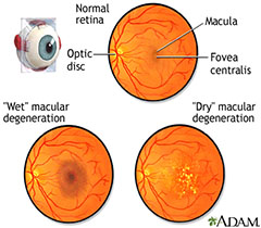 macular_degeneration