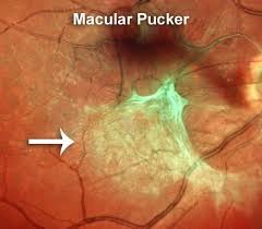 macularpucker