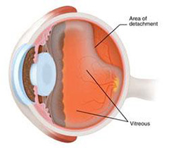 retinal_detachment