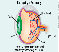 Epiretinal membranes