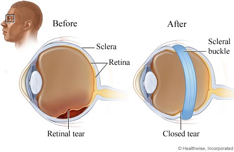 lasertreatment